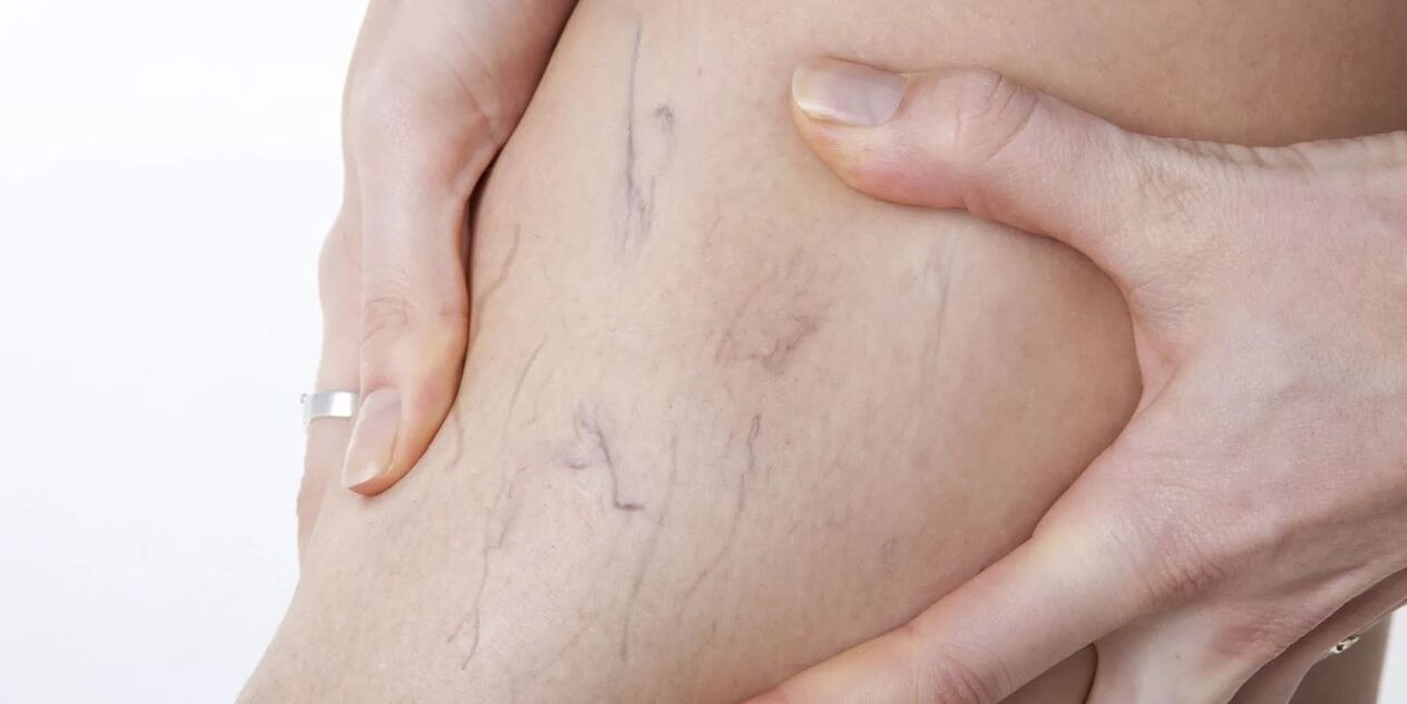 Vor der Verwendung von Varicon -Creme