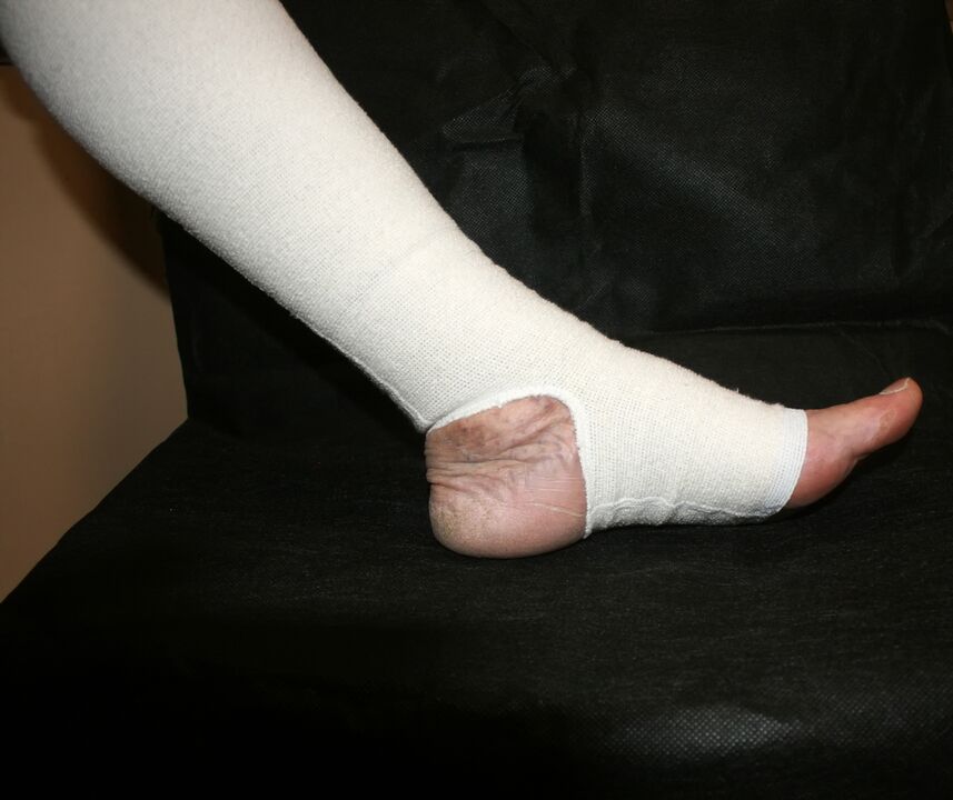 Druckstrickkleidung für Krampfadern